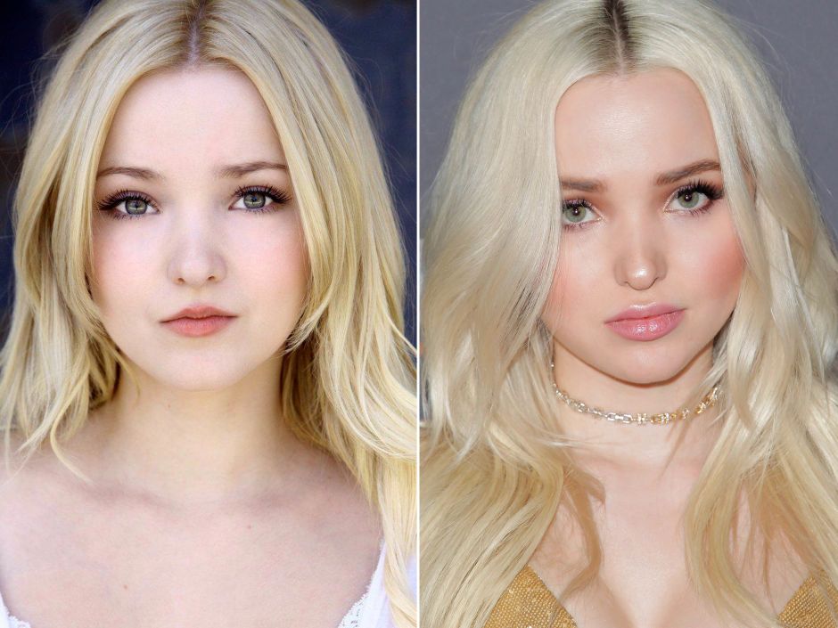 Dove Cameron Before And After Plastic