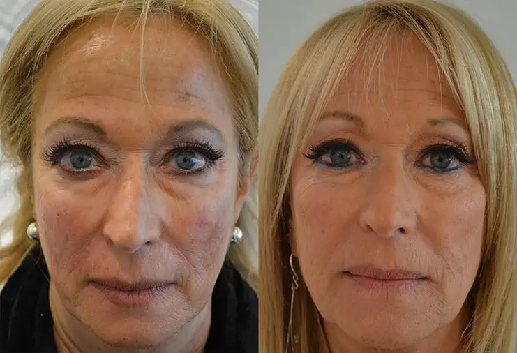 Dermal Fillers Before And After