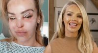 Katie Piper Before and After