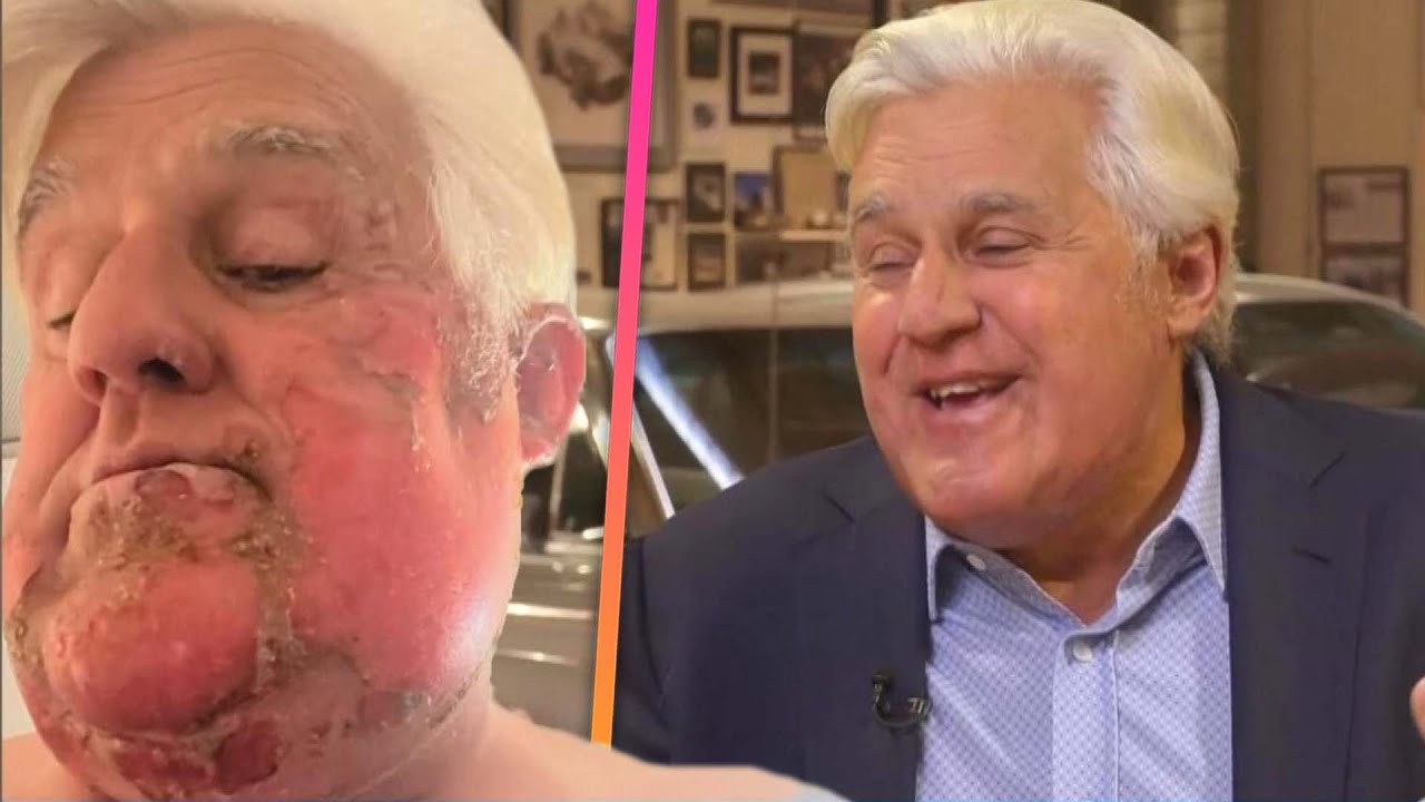 Jay Leno's harsh motorcycle accident 2023 Know it all