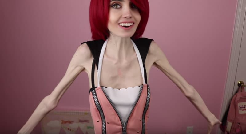 Eugenia Cooney after anorexia nervosa.