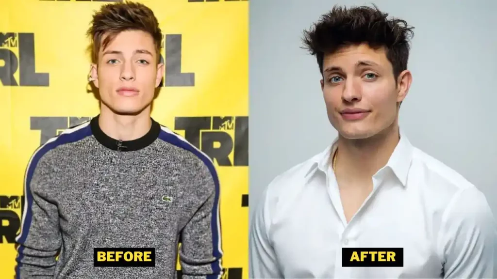 Matt Rife Before And After