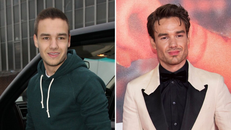 Did Liam Payne Ever Get Plastic Surgery See Photos of His Transformation Jaw Face More