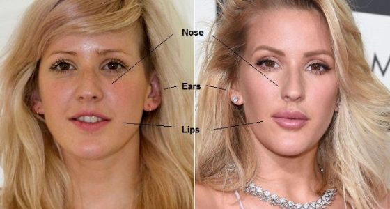 ellie goulding plastic surgery